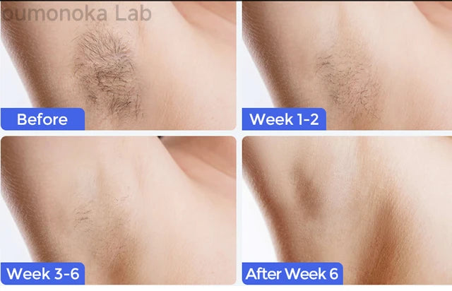 IPL Laser Hair Removal Device