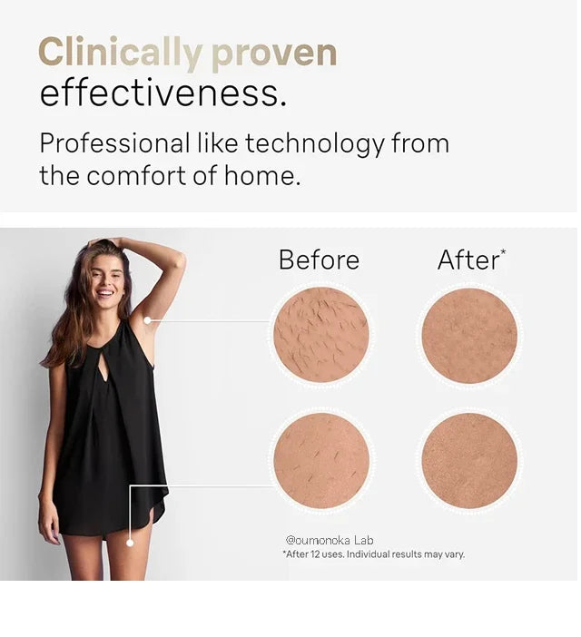 IPL Laser Hair Removal Device
