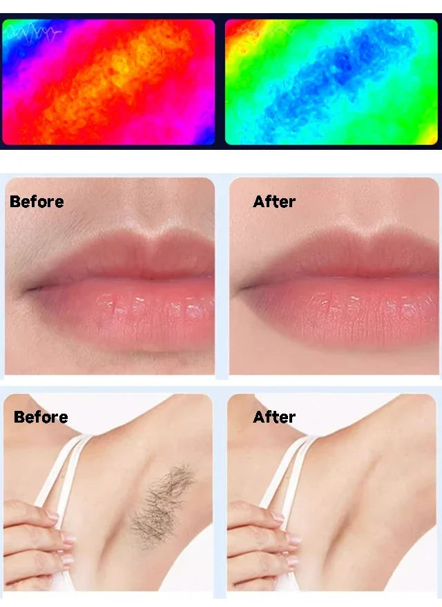 IPL Laser Hair Removal Device