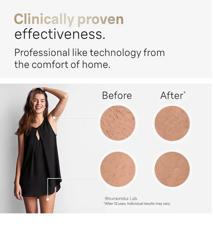 IPL Laser Hair Removal Device